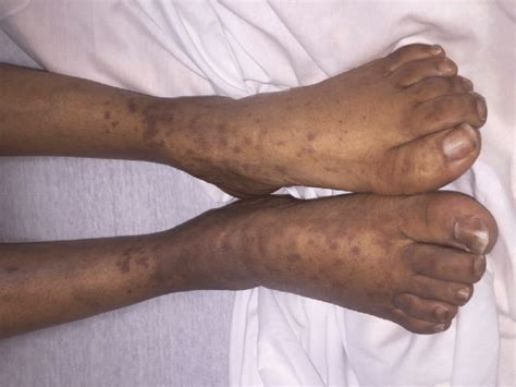 Petechial Rash Found In The Distal Third Of The Legs And The Feet