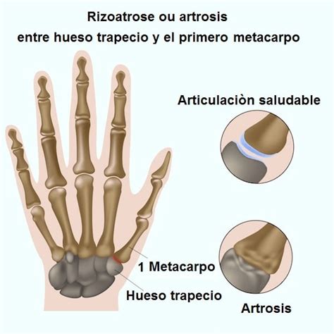 Artrosis De Mano Y Dedos Sintomas Dolor Tratamiento Y Fisioterapia