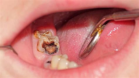 Painless Tooth Extraction Treatment In Salt Lake Kolkata Avant Dental