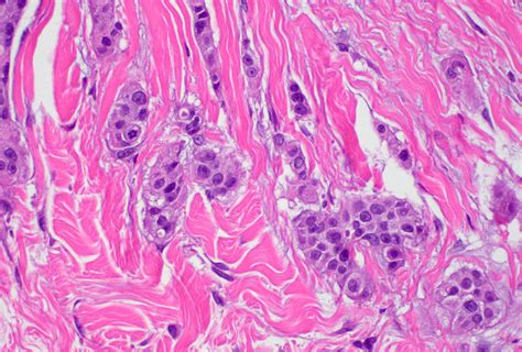 Pathology Outlines Histologic Grading