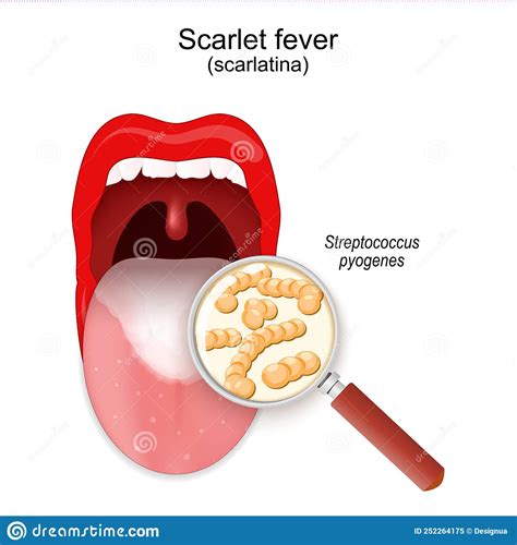 Scarlet Fever Close Up Of Colony Of Streptococcus Stock Vector