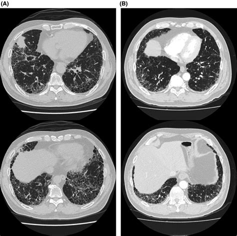 High‐resolution Computed Tomography Hrct Images Of The Chest In