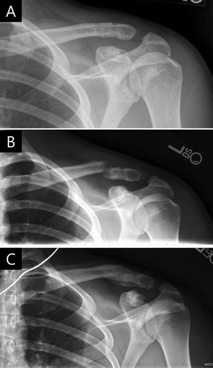 A Rockwood Type Iii Acromioclavicular Ac Joint Injury In An Ice
