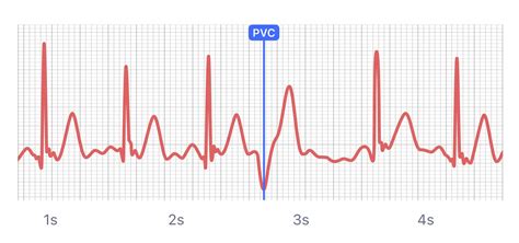 What Heart Palpitations And Irregular Heartbeats Look Like On Your
