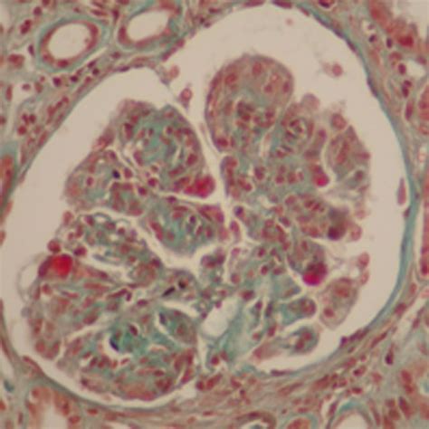 Renal Biopsy Massons Trichrome Magnification × 200 Nodular