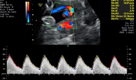 Doppler De Circulaci N Fetoplacentaria Korial Group