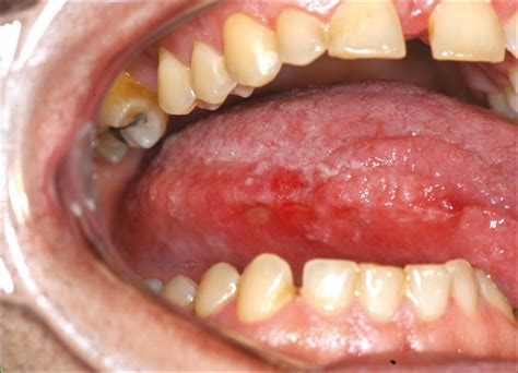 Oral Lesions Associated With Hydroxyurea Treatment Mendonça R Gueiros
