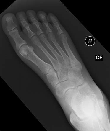 Tarsal Navicular Fractures - Foot & Ankle - Orthobullets