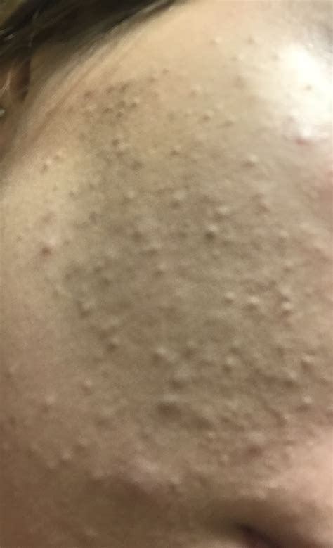 Small Bumps All Over My Face General Acne Discussion Forum
