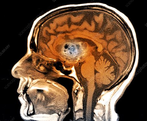 Astrocytoma Brain Cancer Mri Scan Stock Image C0370760 Science