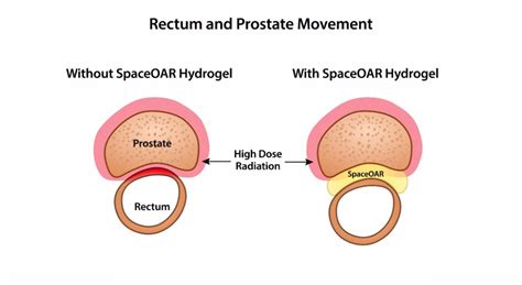 Prostate Cancer Radiation And Rectal Side Effects