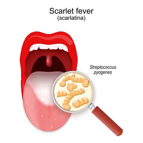 Scarlet Fever Tongue Stock Photos Pictures And Royalty Free Images Istock