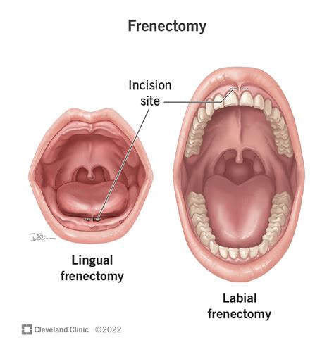 Frenectomy Tongue Tie Waco Tx Creekwood Dental Arts