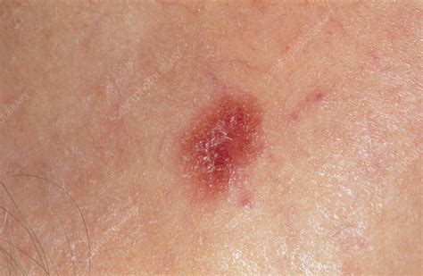 Amelanotic Malignant Melanoma Skin Cancer Stock Image M