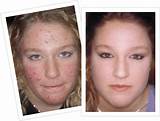 Pictures of Is Laser Treatment Good For Acne