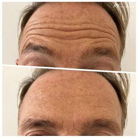 Anti Wrinkle Treatments With Muscle Relaxants From £99 M1 Med Beauty