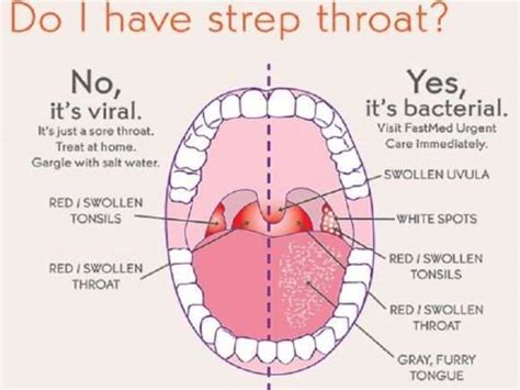 Strep Throat Is A Bacterial Infection Of The Throat And Tons