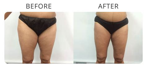 Liposuction Before And After Gallery Mcc Sydney