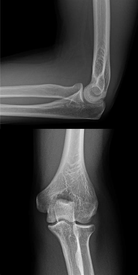 Traumatic Elbow Injury Radiology U Of U School Of Medicine