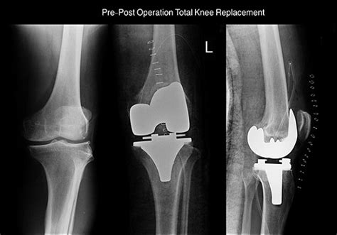 Total Knee Replacement Tkr