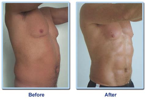 Vaser Liposuction In Abs Before And After Photos Vaser Liposuction