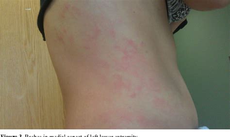 Figure 3 From Lamotrigine Overdose Cause Skin Rash And Angioedema