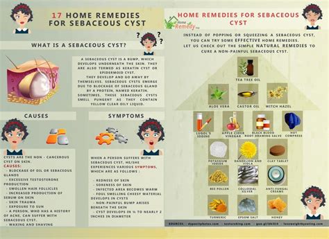 17 Home Remedies For Sebaceous Cyst Home Remedies