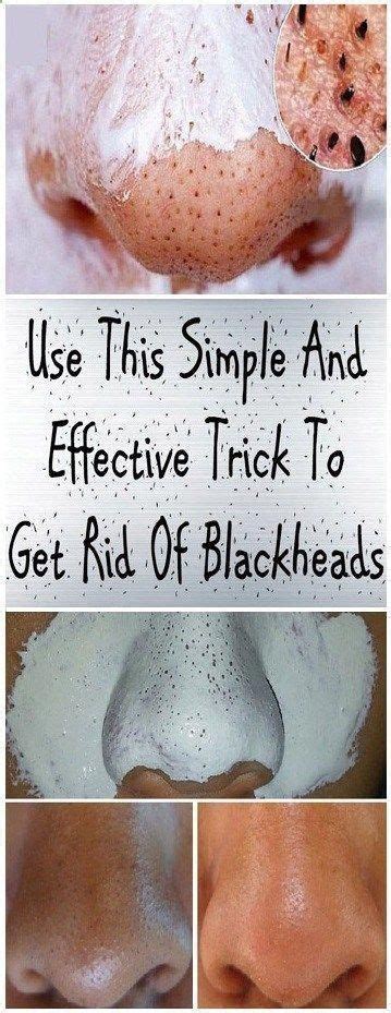 Simple And Effective Trick To Get Rid Of Blackheads Health Get Rid