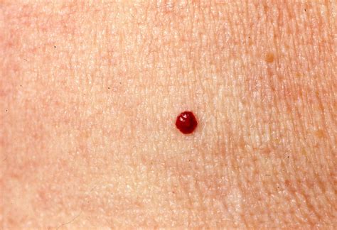 Cherry Angioma Cherry Angiomas Pictures Symptoms Causes