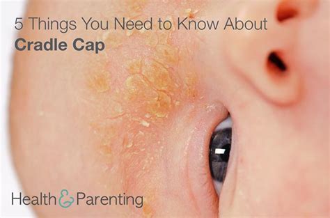 5 Things You Need To Know About Cradle Cap Philips