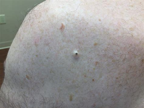 Gigantic Blackheads Dilated Pore Of Winer Explained The Pretty