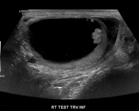 A 58 Year Old Man Presenting With A Cystic Neoplasm Of The Testis