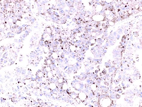 Section Of Ovarian Clear Cell Carcinoma Demonstrating Strong