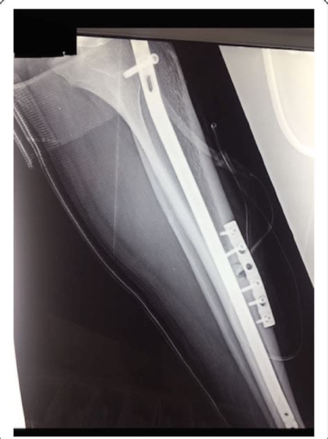 Tension Band Plating Of The Anterior Tibia Stress Fracture Nonunion