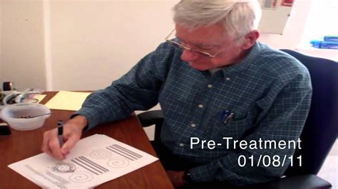 World S First Essential Tremor Patient Treated With Mr Guided Focused Ul Essential Tremors