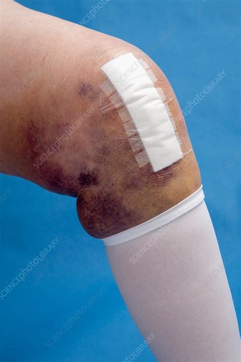 Knee One Week After Joint Replacemen Stock Image C0142413
