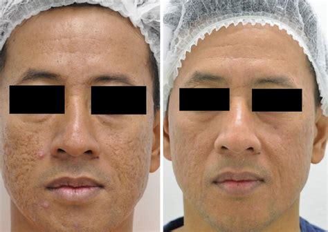 Co2 Laser Acne Scar Removal Rejuvenation With Electrophoresis And