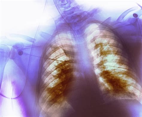 Inhale through your nose and exhale through your mouth. A Lethargic 67-Year-Old Woman Presents With Shortness of Breath - The Cardiology Advisor