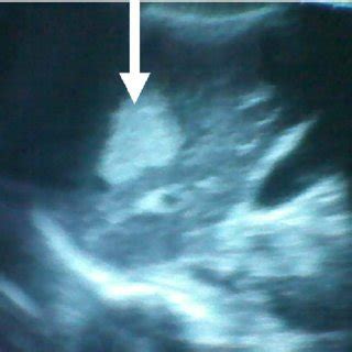 Longitudinal Ultrasound Image Of The Liver Of A Year Old Hiv Download Scientific Diagram