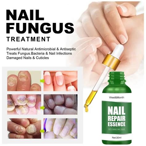 Nail Repair Liquidtreatment Of Onychomycosis Paronychia Anti Fungal Nail Repair Serum Nail Care
