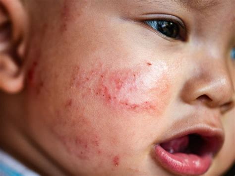 Apa Itu Eczema Dan Bagaimana Nak Merawat Poliklinik Az Zaara Ampang