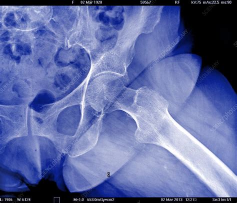 Hip X Ray Stock Image C0231281 Science Photo Library