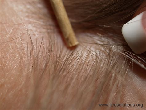 Nits And Head Lice Causes Symptoms Treatment Nits And Head Lice
