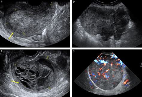 Imaging In Gynecological Disease 15 Clinical And Ultrasound