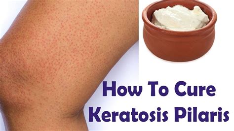 Home Remedies For Keratosis Pilaris Bumps On The Skin