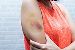 Bruises - Why We Get Them - Health Beat