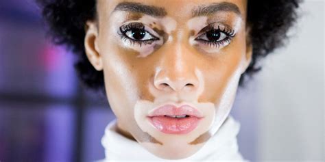 Santé Les Traitements Médicaux Du Vitiligo