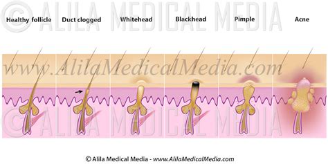 Formation Of Skin Blackhead Whitehead Pimples And Acne Alila Medical Images