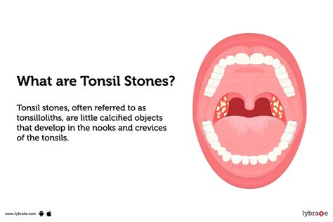 Tonsil Stones Symptoms Causes Treatments And Cost