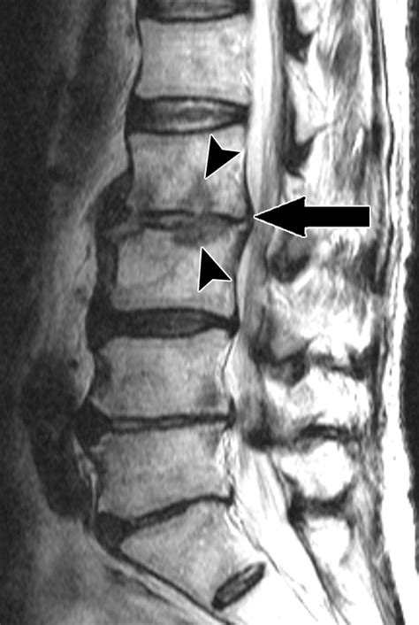 Mr Imaging Assessment Of The Spine Infection Or An Imitation